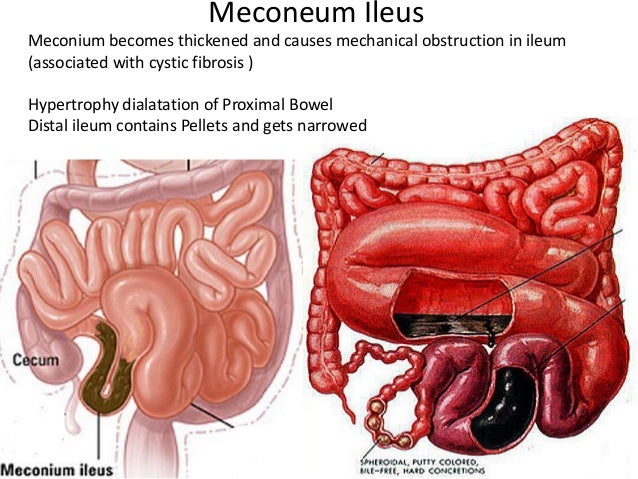 ileus diagram wiring diagram Ileus Anatomy pathopyshiology of intestinal obstruction chirantan mandal medical co\\u2026meconeum ileusmeconium becomes thickened and causes mechanical